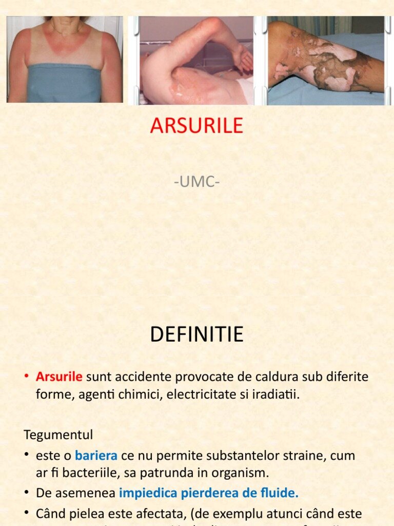 Aplicarea pe arsură poate agrava inflamația.