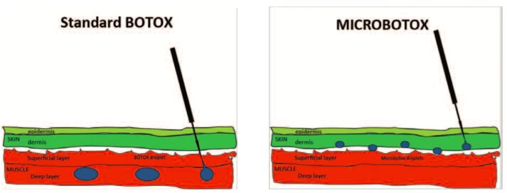 Beneficiile microbotoxului