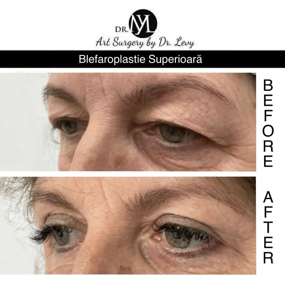 Blefaroplastie pentru cazuri avansate