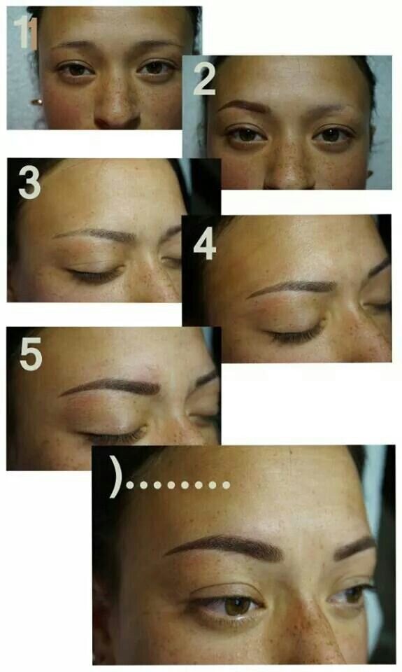 Carboxiterapie, microneedling, depigmentare