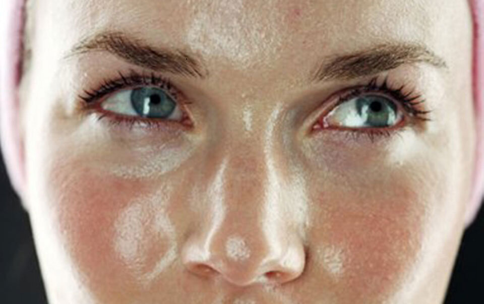 Cauze: sebum, bacterii, factori externi