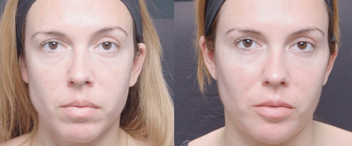 Cinci forme de acid hialuronic