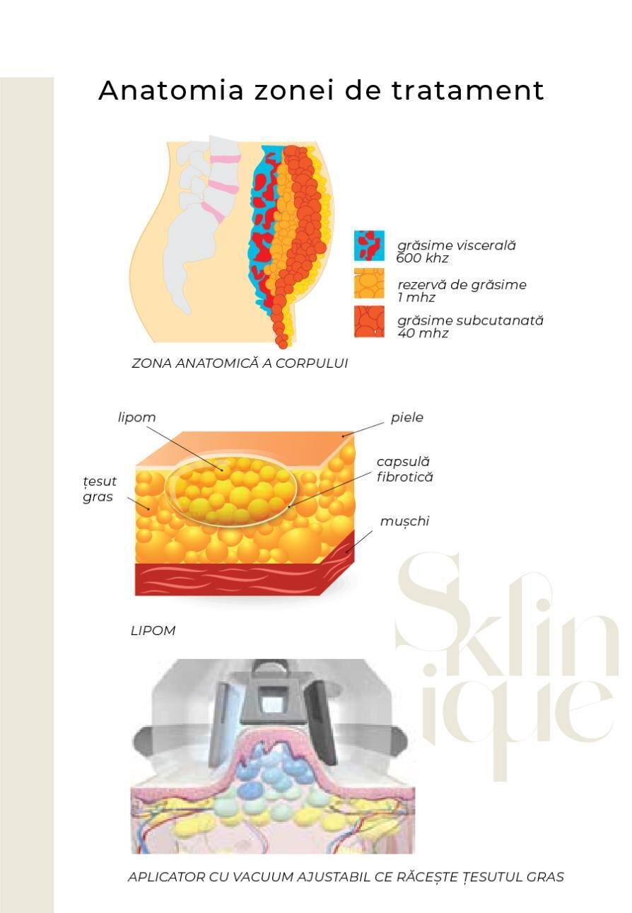 Criolipoliza 3D