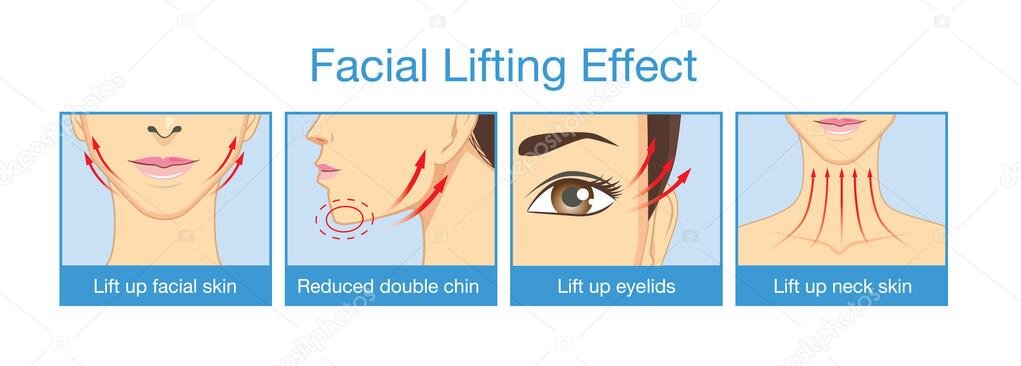 Efect lifting