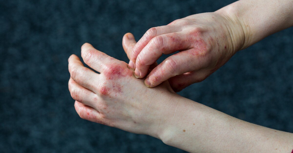 Hipomelanoză în picături și dermatită atopică