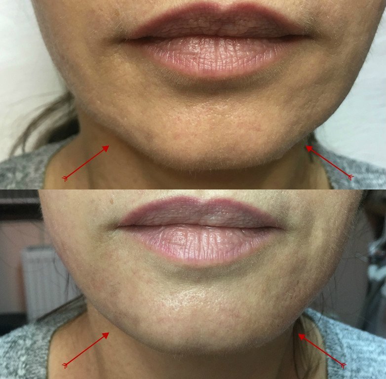 Injecții de acid hialuronic