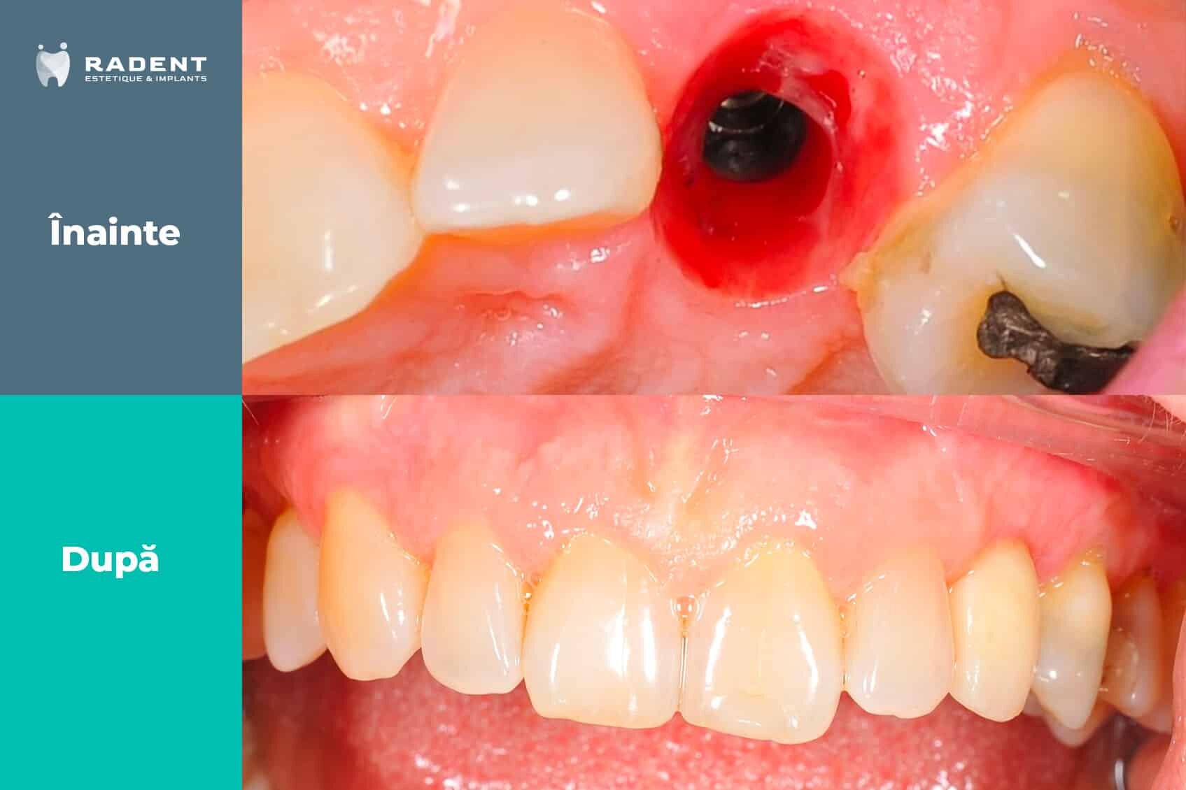 Îmbunătățirea ocluziei dentare