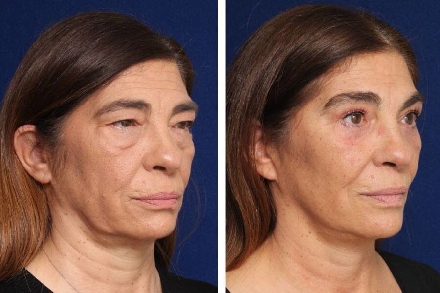 Minilifting facial