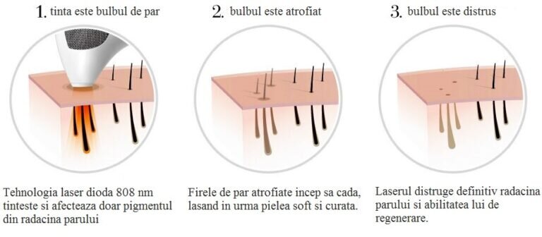Îndepărtarea firelor de păr