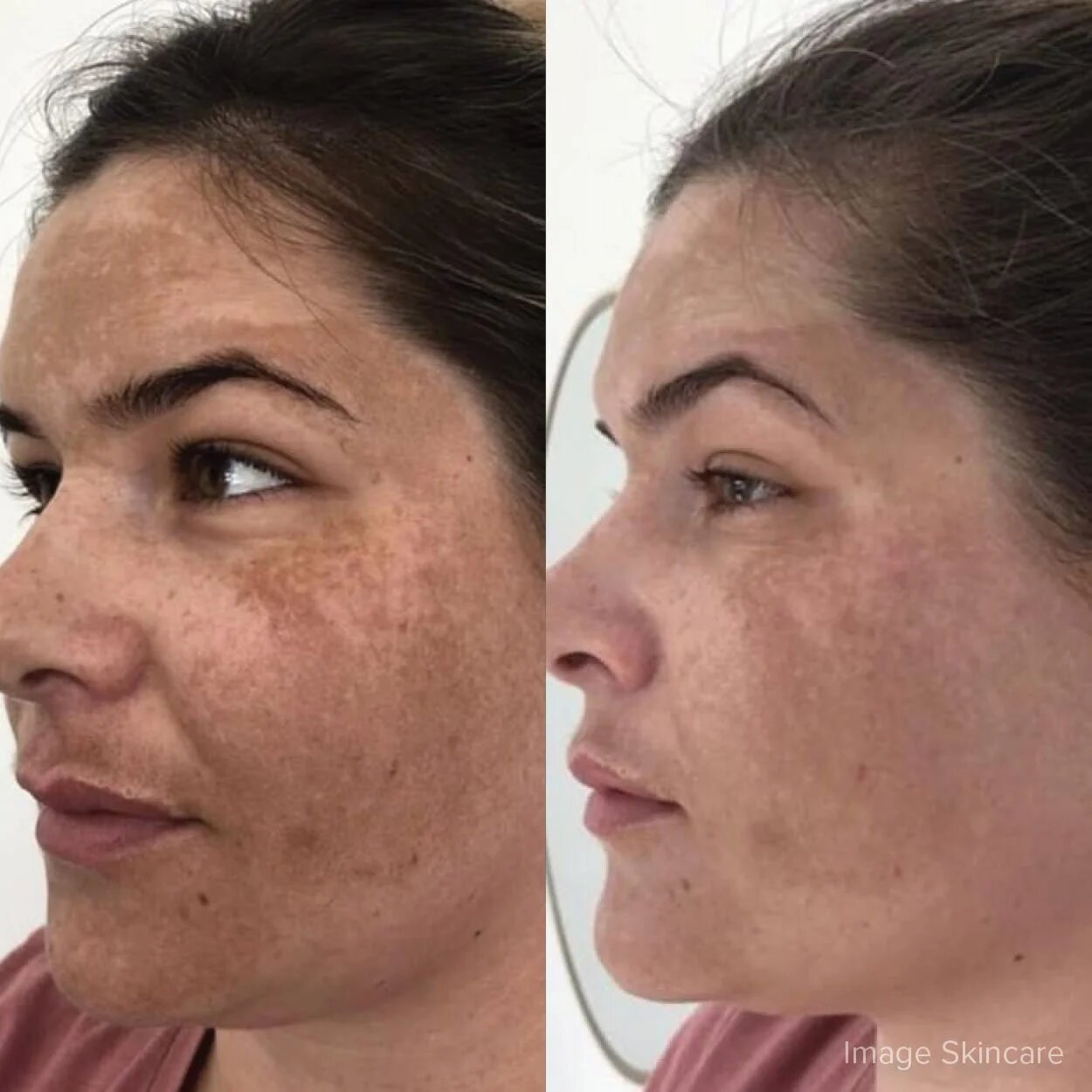 Peeling-ul facial