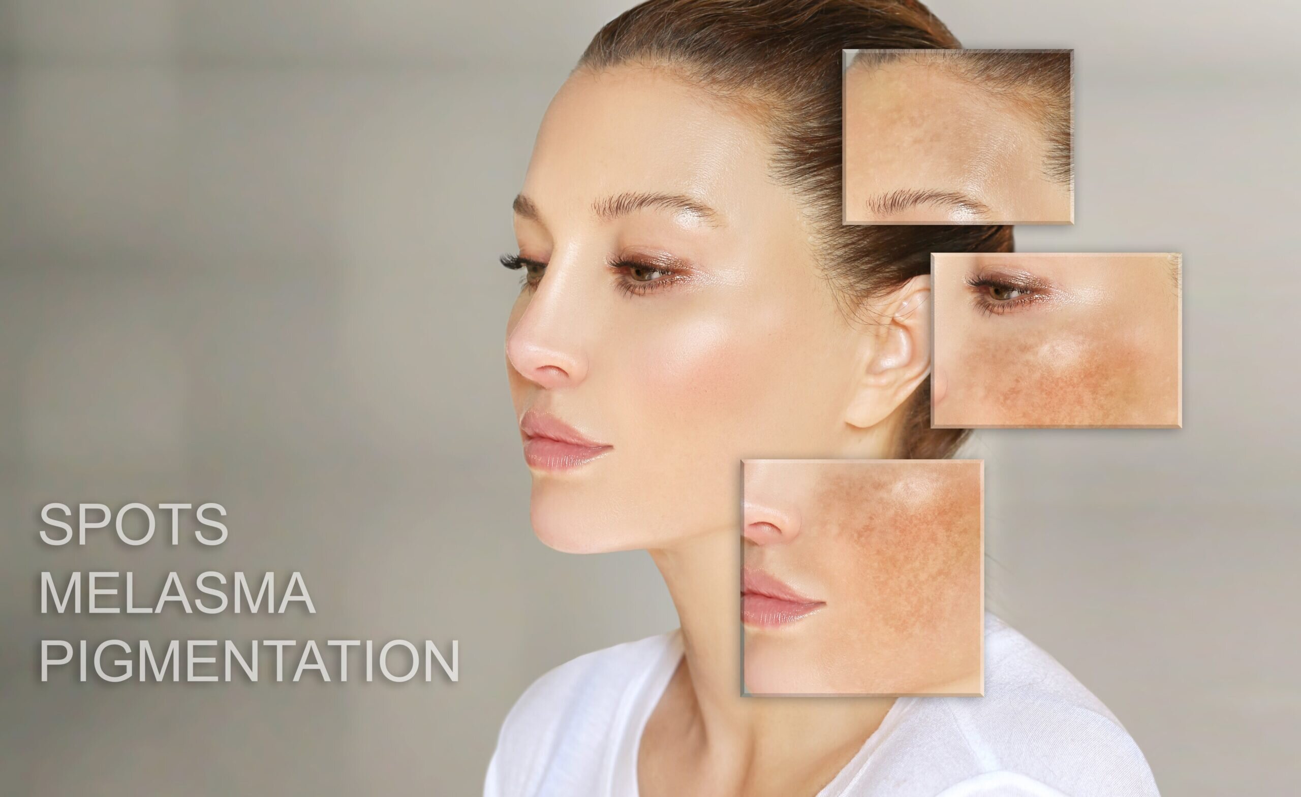 Remedierea petelor post-acneice