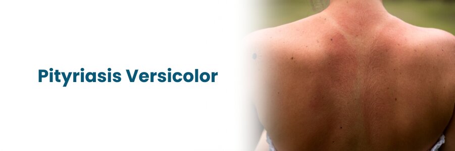 Tipuri de infecții fungice: Pitiriasis versicolor