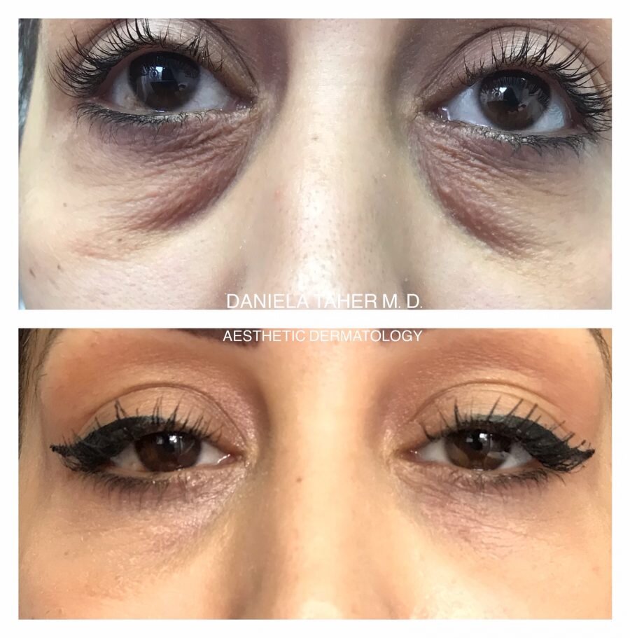 Tratament complex (neuromodulatori, acid hialuronic)